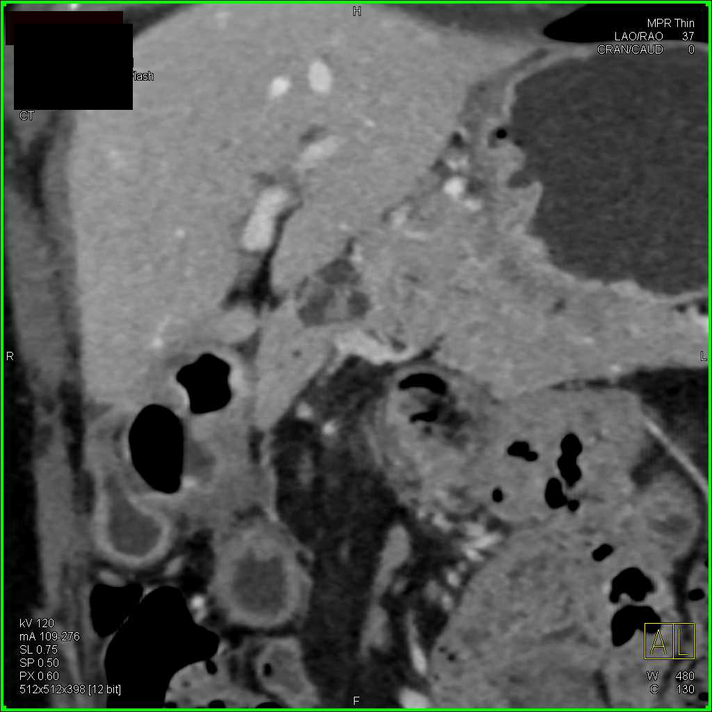 Intraductal Papillary Mucinous Neoplasm (IPMN) with Thick Septation - CTisus CT Scan