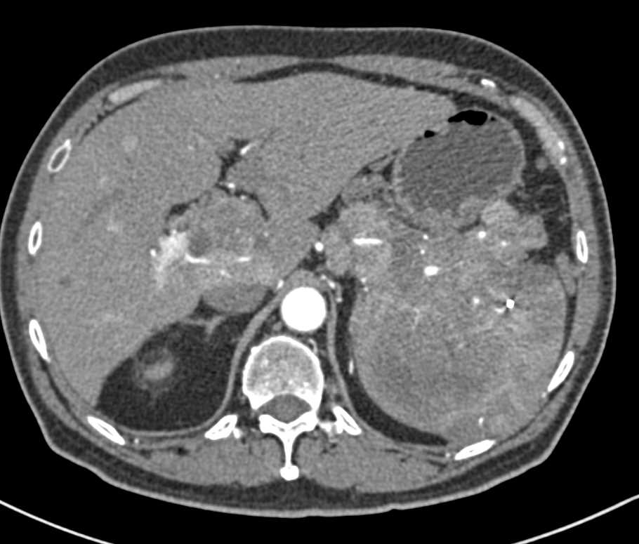 Neuroendocrine Tumor of the Pancreas Invades the Spleen and Extends from Splenic Vein Into Portal Vein - CTisus CT Scan