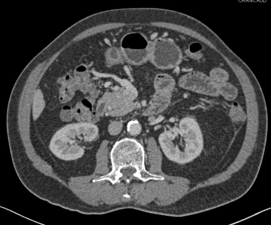 Neuroendocrine Tumor of the Pancreas Invades the Spleen and Extends from Splenic Vein Into Portal Vein - CTisus CT Scan