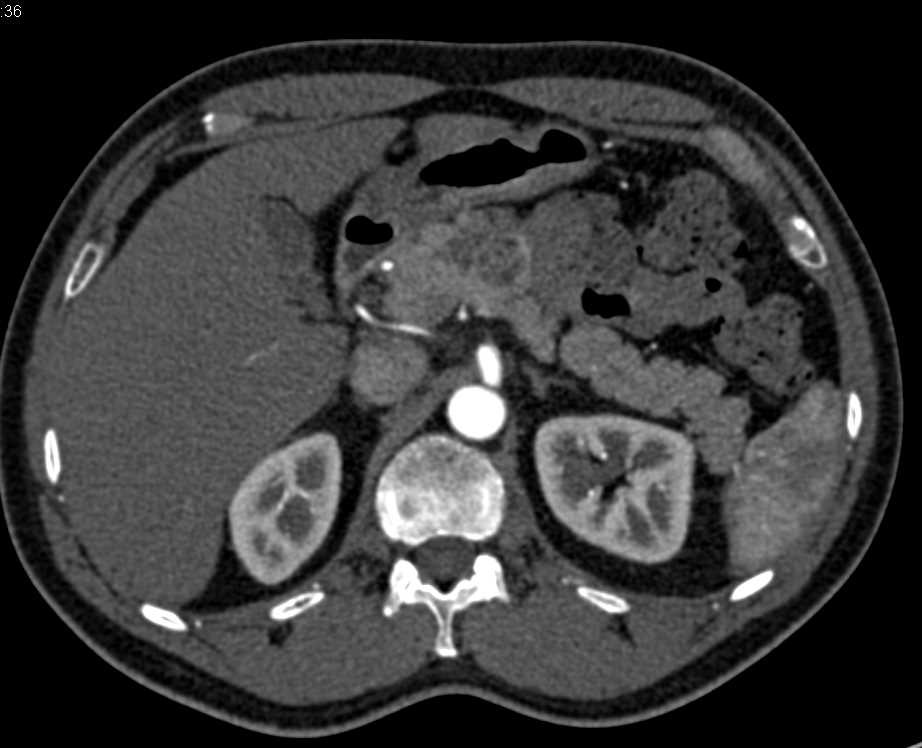 Serous Cystadenoma Pancreas - CTisus CT Scan