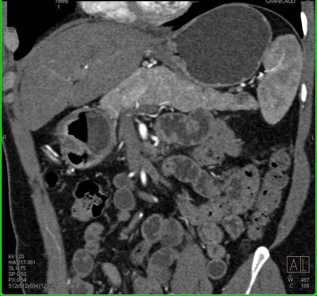 1 cm Pancreatic Adenocarcinoma - CTisus CT Scan