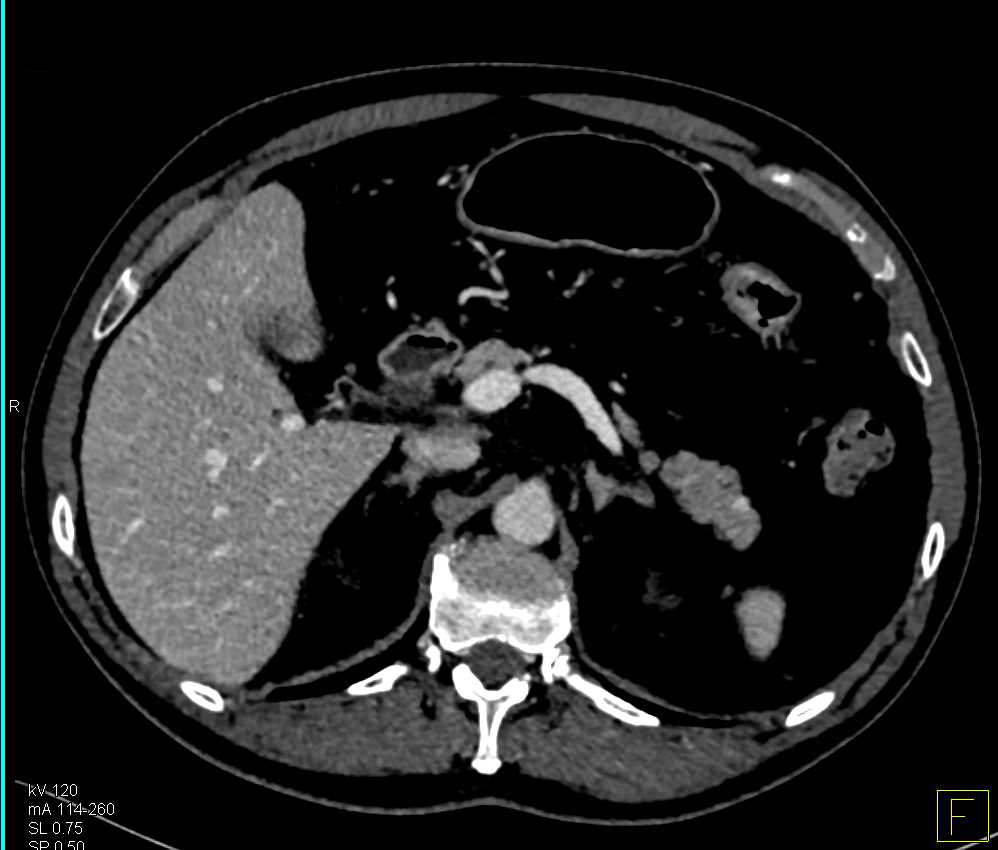 Small Neuroendocrine Tumor in Tail of Pancreas - CTisus CT Scan