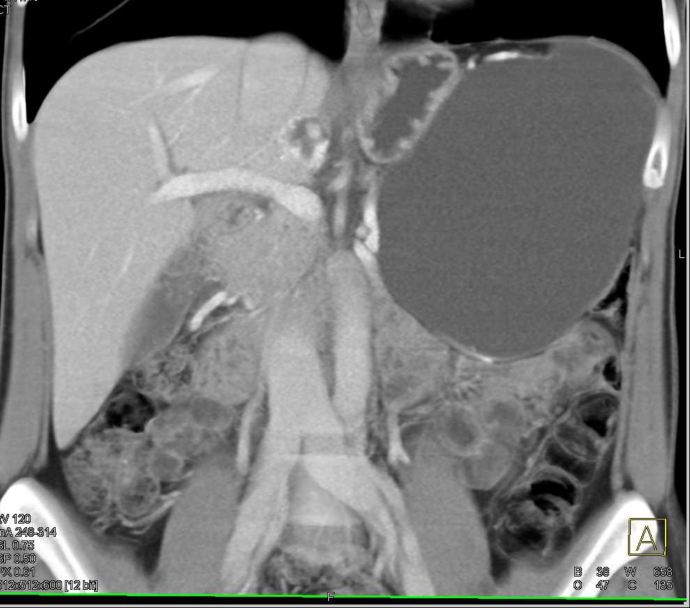 Pancreatic Pseudocyst - CTisus CT Scan