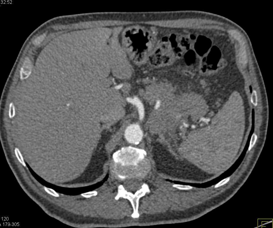 Carcinoma Tail of the Pancreas - CTisus CT Scan