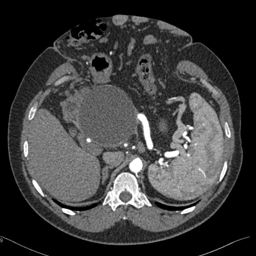 Pseudocyst with Vascular Compression and Collaterals - CTisus CT Scan