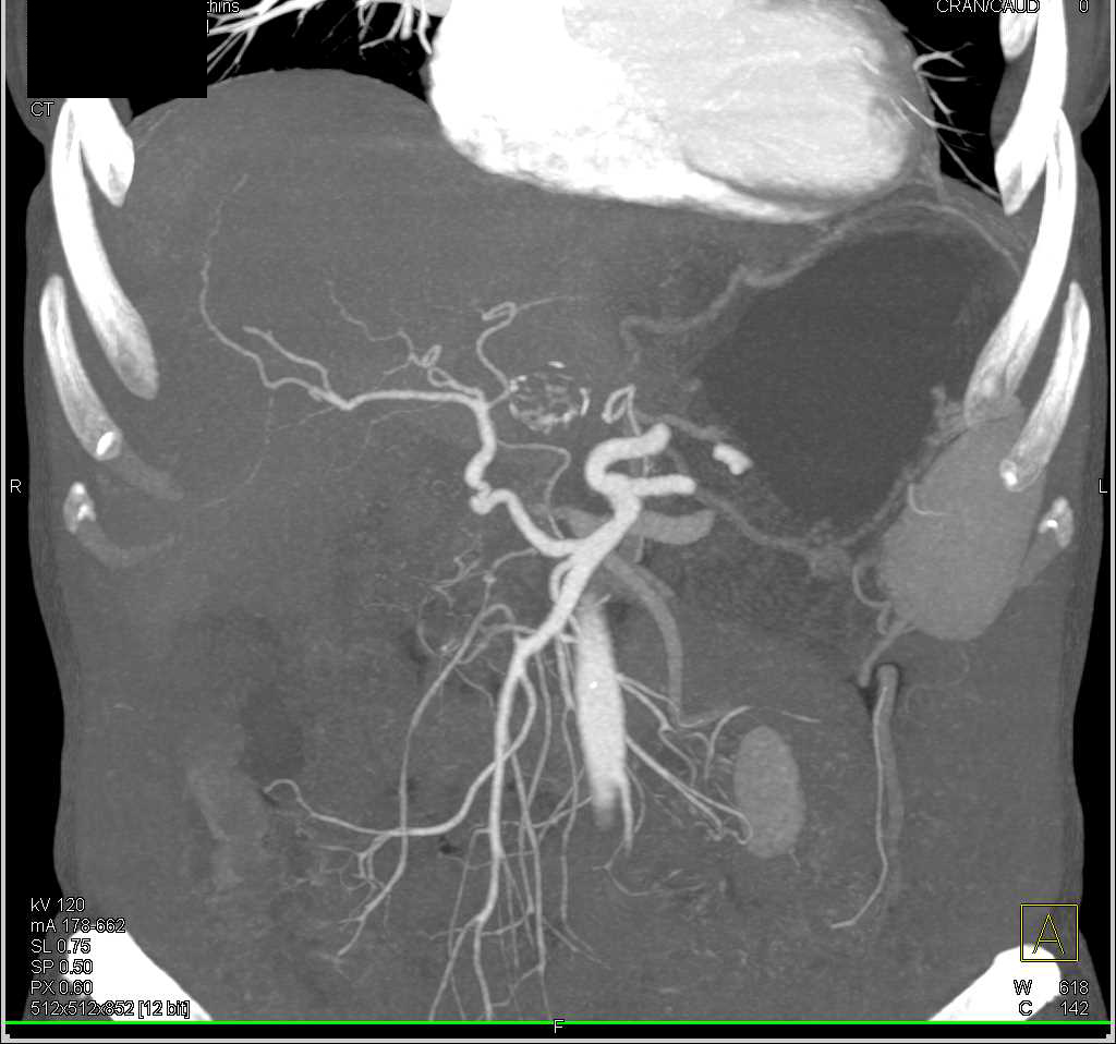 Pancreatic Cancer Encases the Portal Vein and Superior Mesenteric Vein (SMV) - CTisus CT Scan