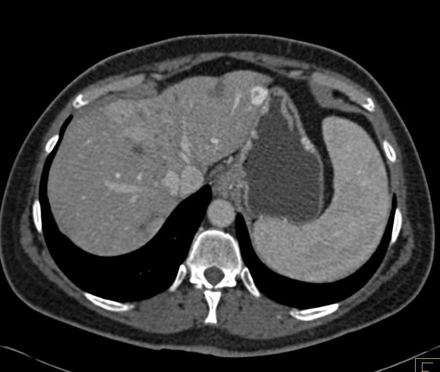 Subtle Pancreatic Adenocarcinoma with Superior Mesenteric Vein (SMV) Encasement - CTisus CT Scan