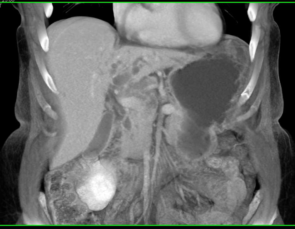 Pancreatic Cancer Extends to Hilum of the Liver - CTisus CT Scan