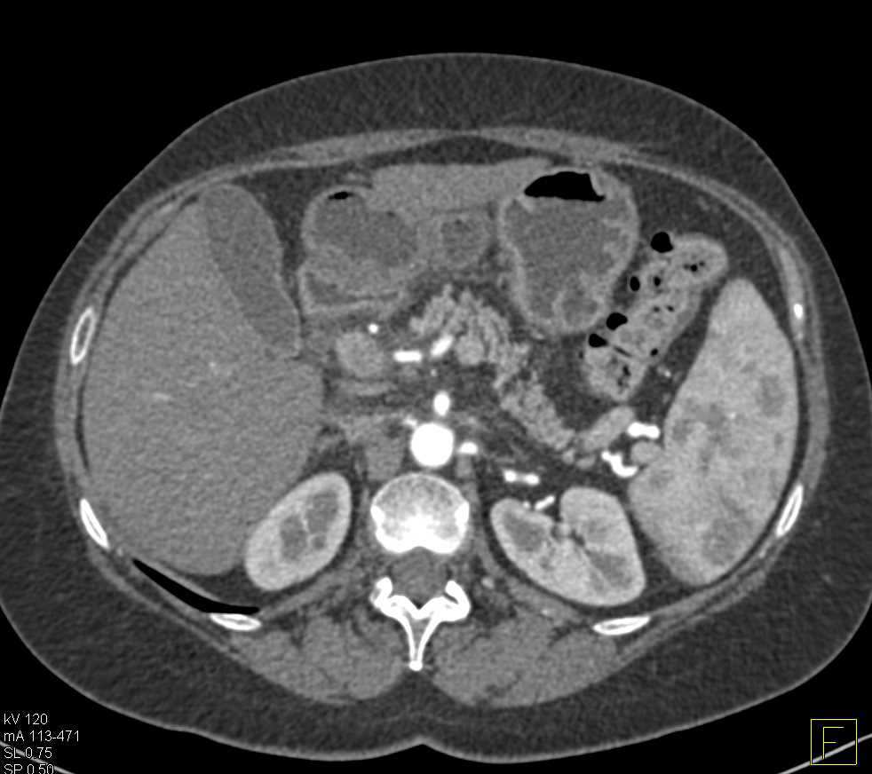 Neuroendocrine Tumor n the Head of the Pancreas - CTisus CT Scan