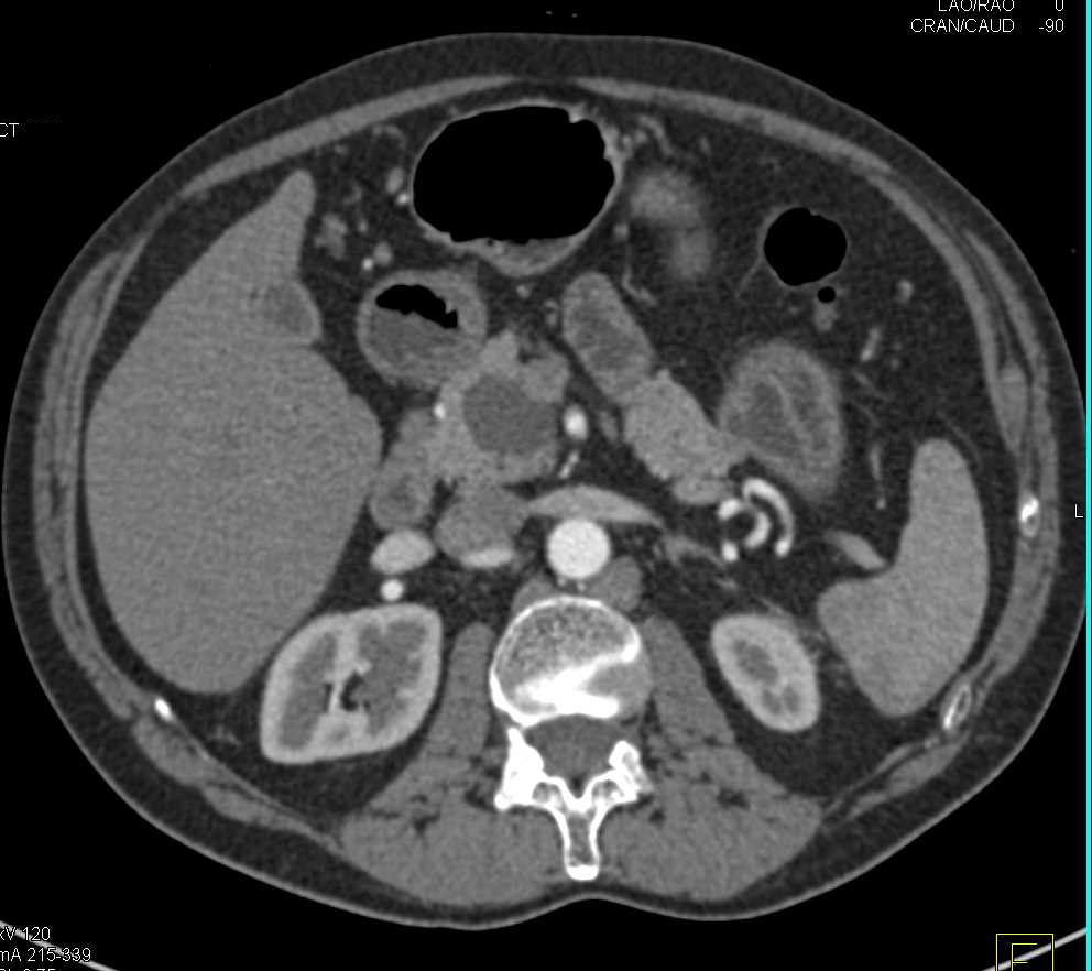 Intraductal Papillary Mucinous Neoplasm (IPMN) in the Head of the Pancreas - CTisus CT Scan