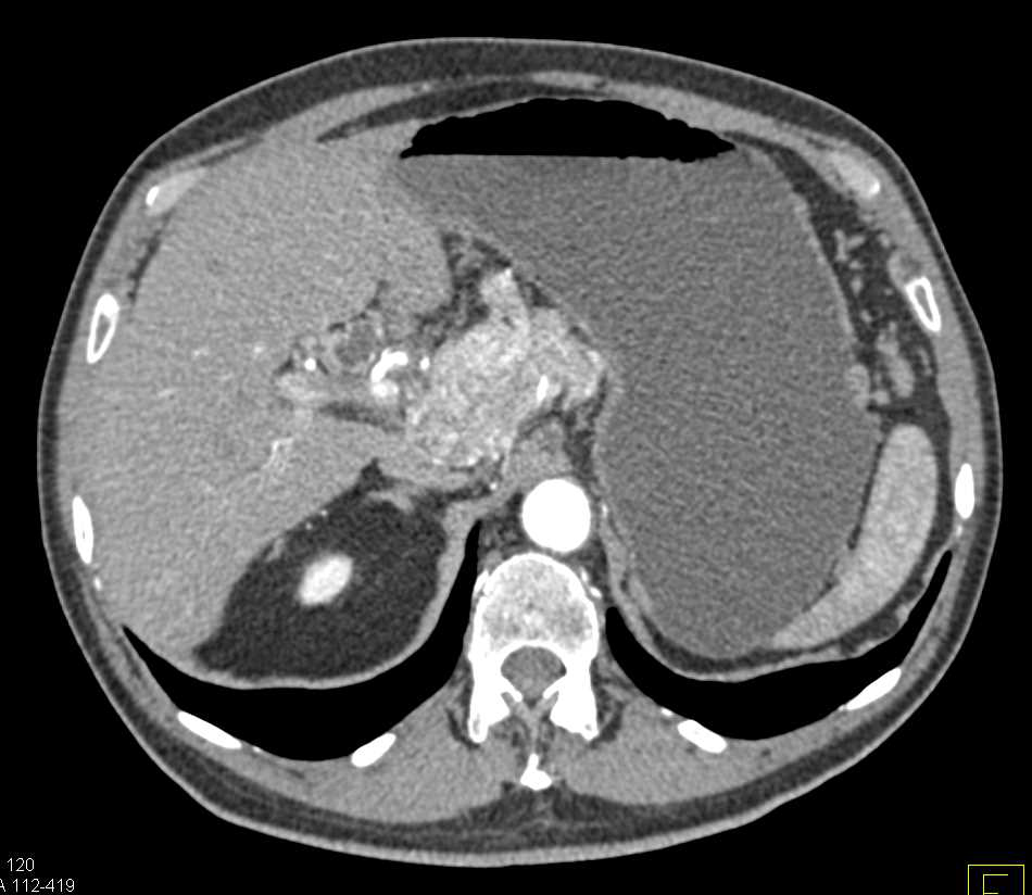 Neuroendocrine Tumor in the Head of the Pancreas with Cavernous Transformation of the Portal Vein (CTPV) - CTisus CT Scan