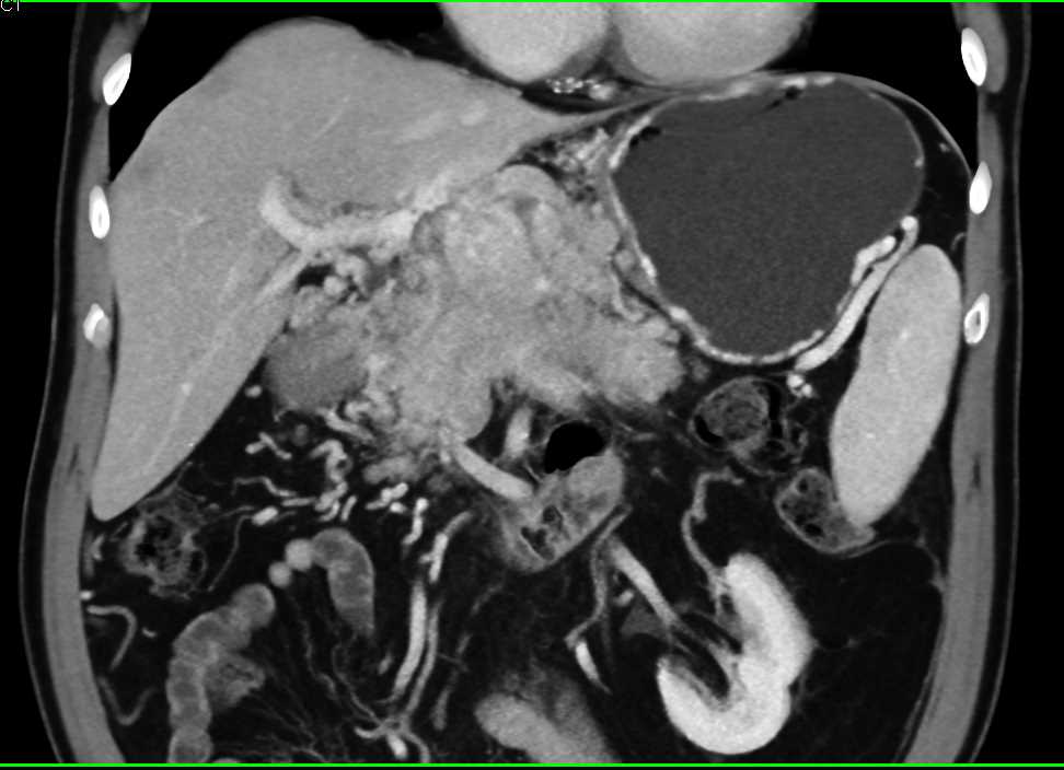 Neuroendocrine Tumor in the Head of the Pancreas with Cavernous Transformation of the Portal Vein (CTPV) - CTisus CT Scan