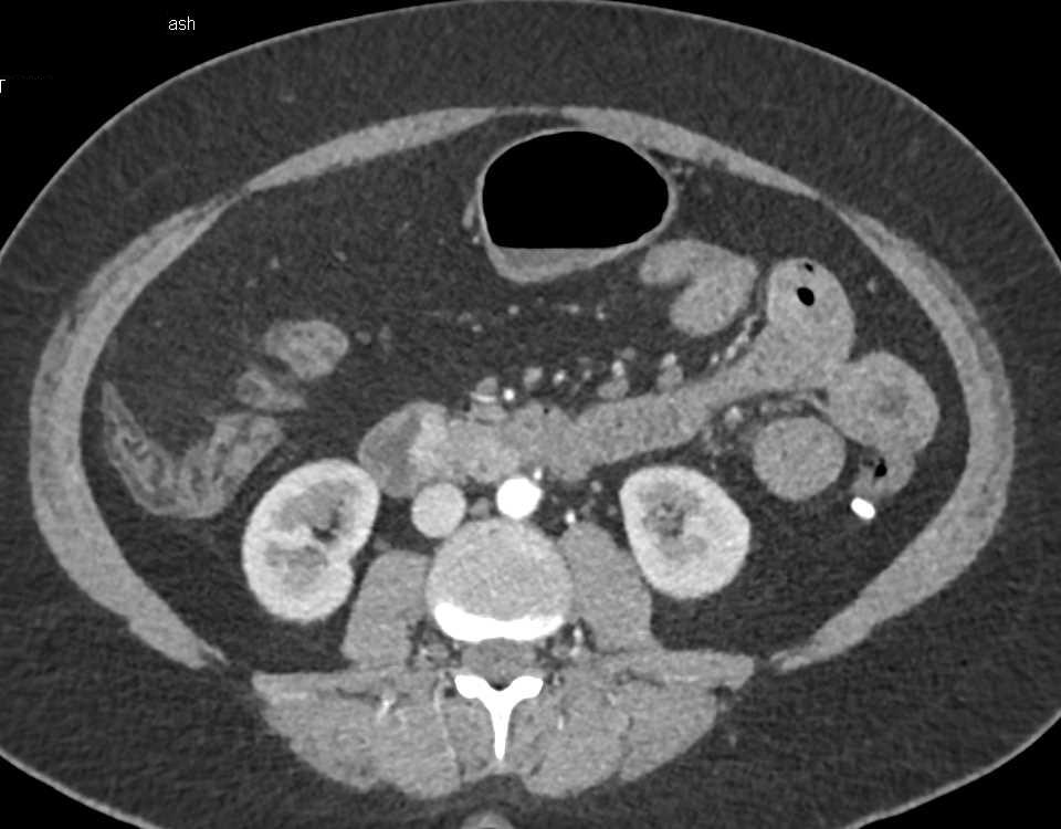 Carcinoma in the Ampulla Arising from a Villous Adenoma - CTisus CT Scan