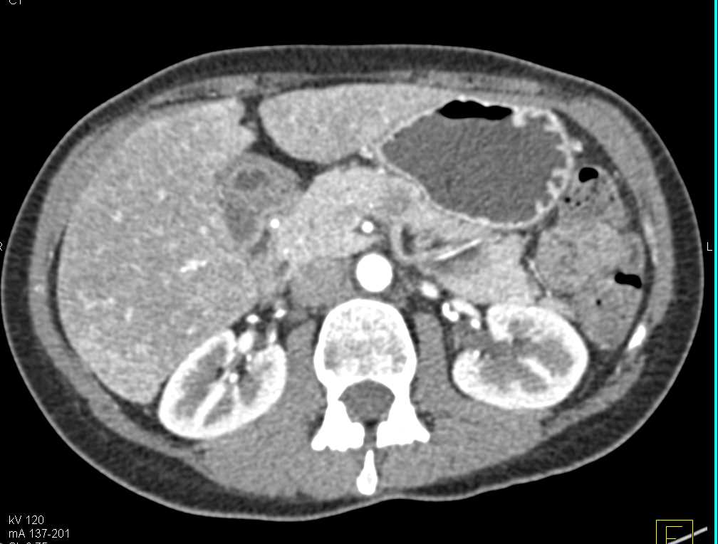Subtle Adenocarcinoma of the Body of the Pancreas Best Seen on Venous Phase Views - CTisus CT Scan