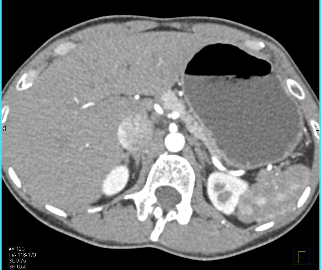 Incidental Neuroendocrine Tumor in the Body/Tail of the Pancreas - CTisus CT Scan