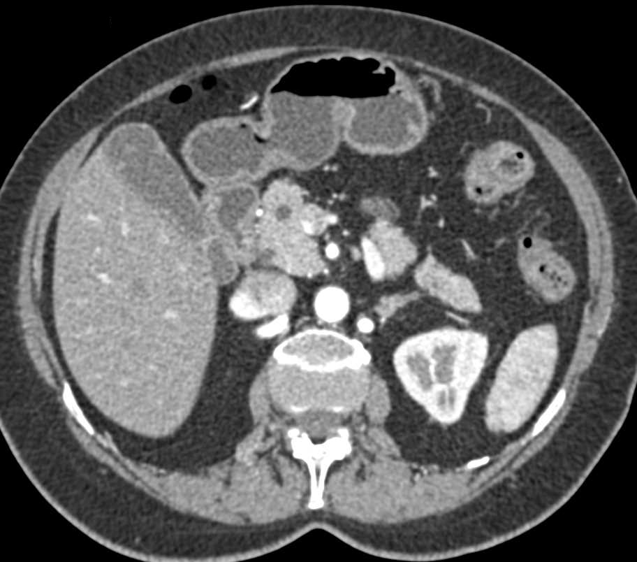 Intraductal Papillary Mucinous Neoplasm (IPMN) with Dilated Pancreatic Duct - CTisus CT Scan