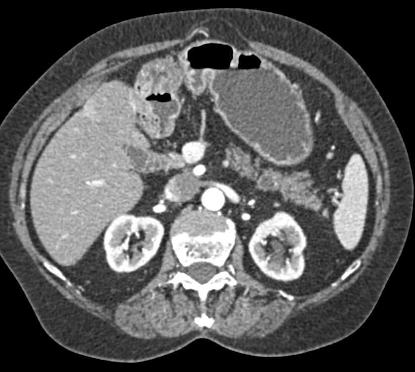 Pancreatic Carcinoma in the Tail of Pancreas with Prior Whipple Procedure - CTisus CT Scan