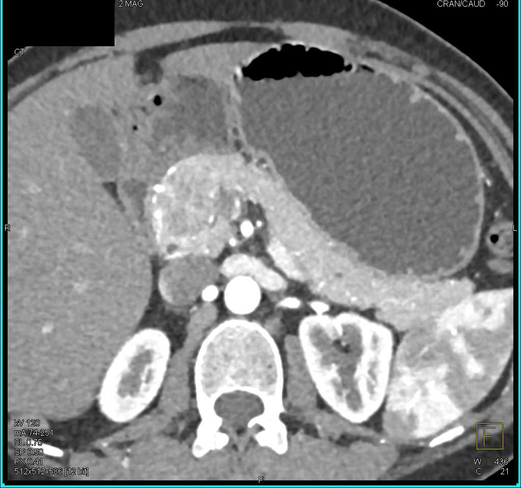 Serous Cystadenoma of the Head of the Pancreas - CTisus CT Scan