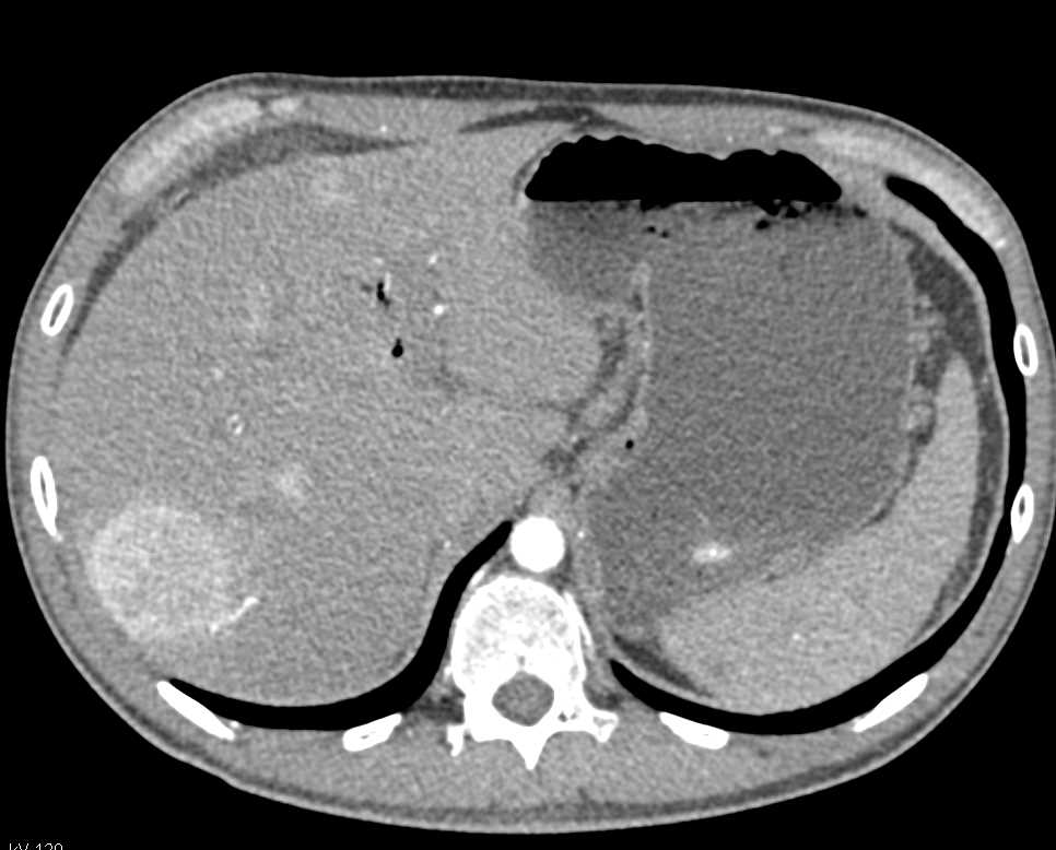 Neuroendocrine Tumor of the Pancreas with Liver Metastases - CTisus CT Scan
