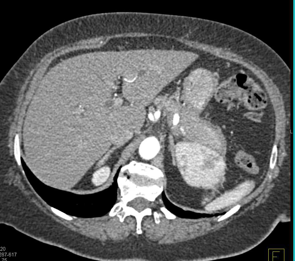Autoimmune Pancreatitis - CTisus CT Scan
