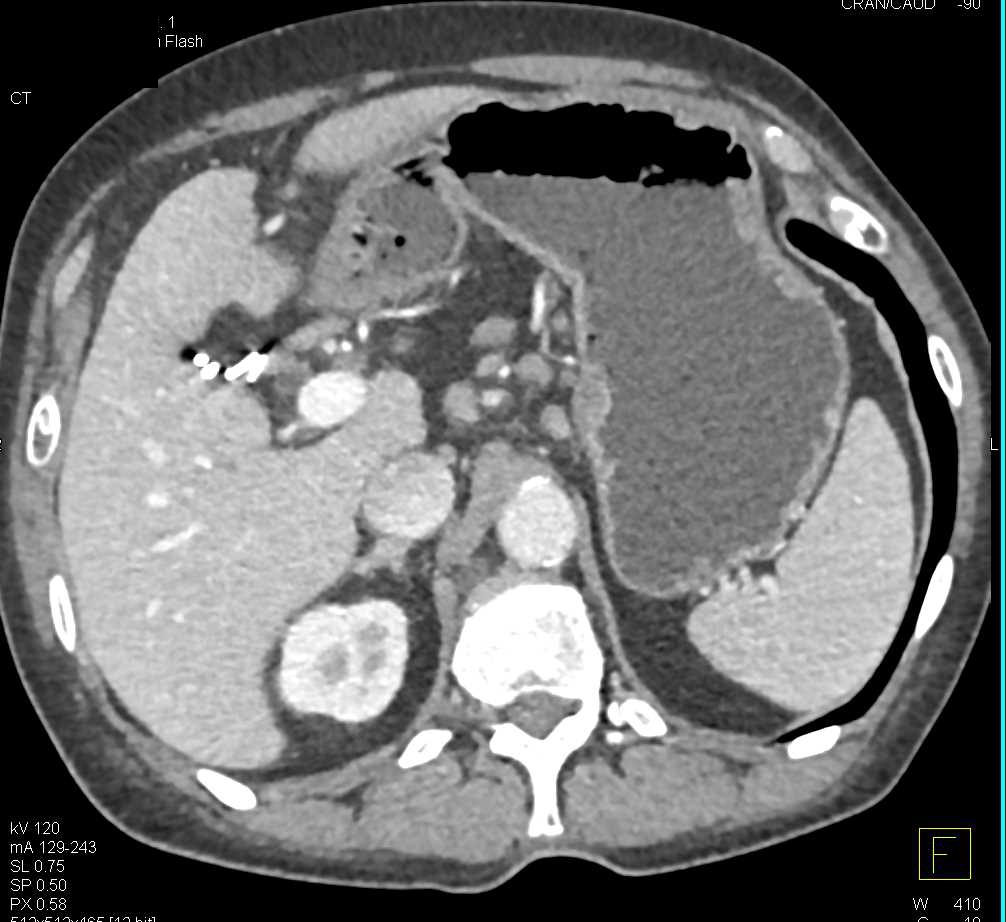 Chronic Pancreatitis - CTisus CT Scan