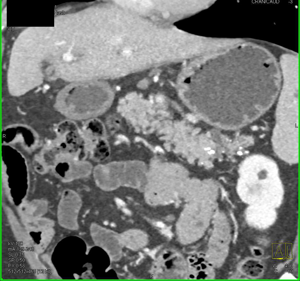 Chronic Pancreatitis - CTisus CT Scan