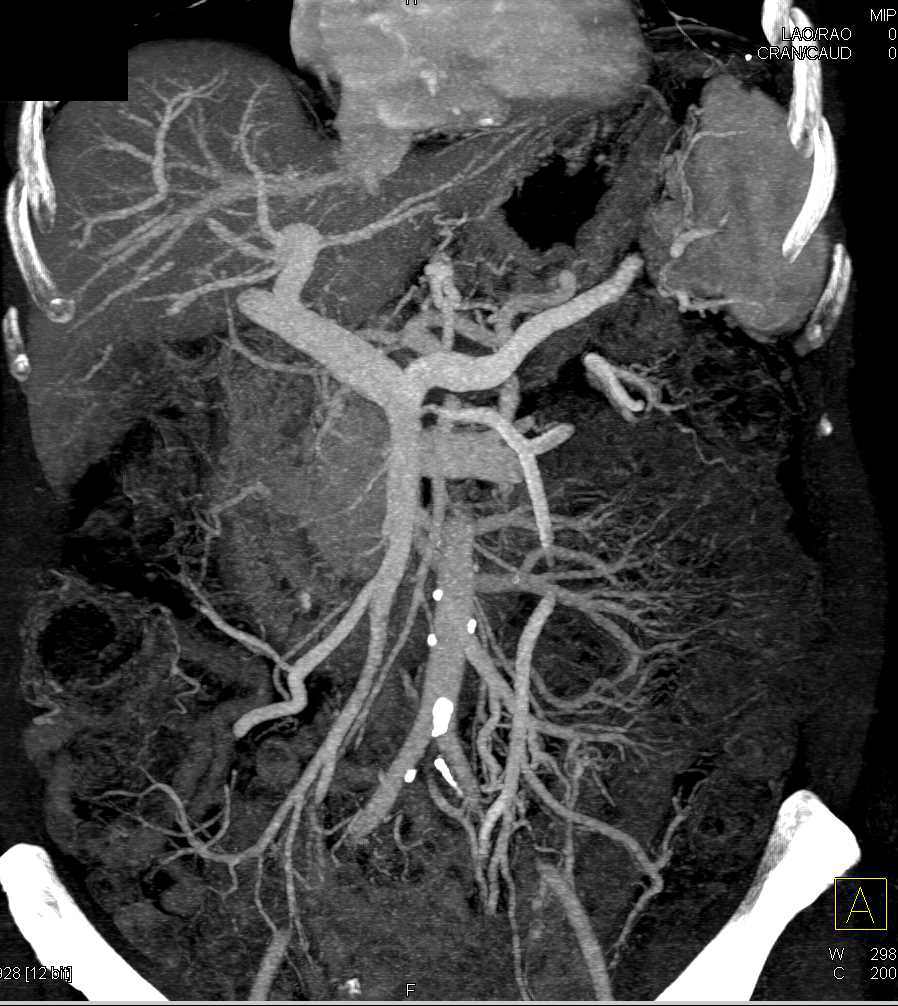 Pancreatic Cancer with Splenic Metastases - CTisus CT Scan