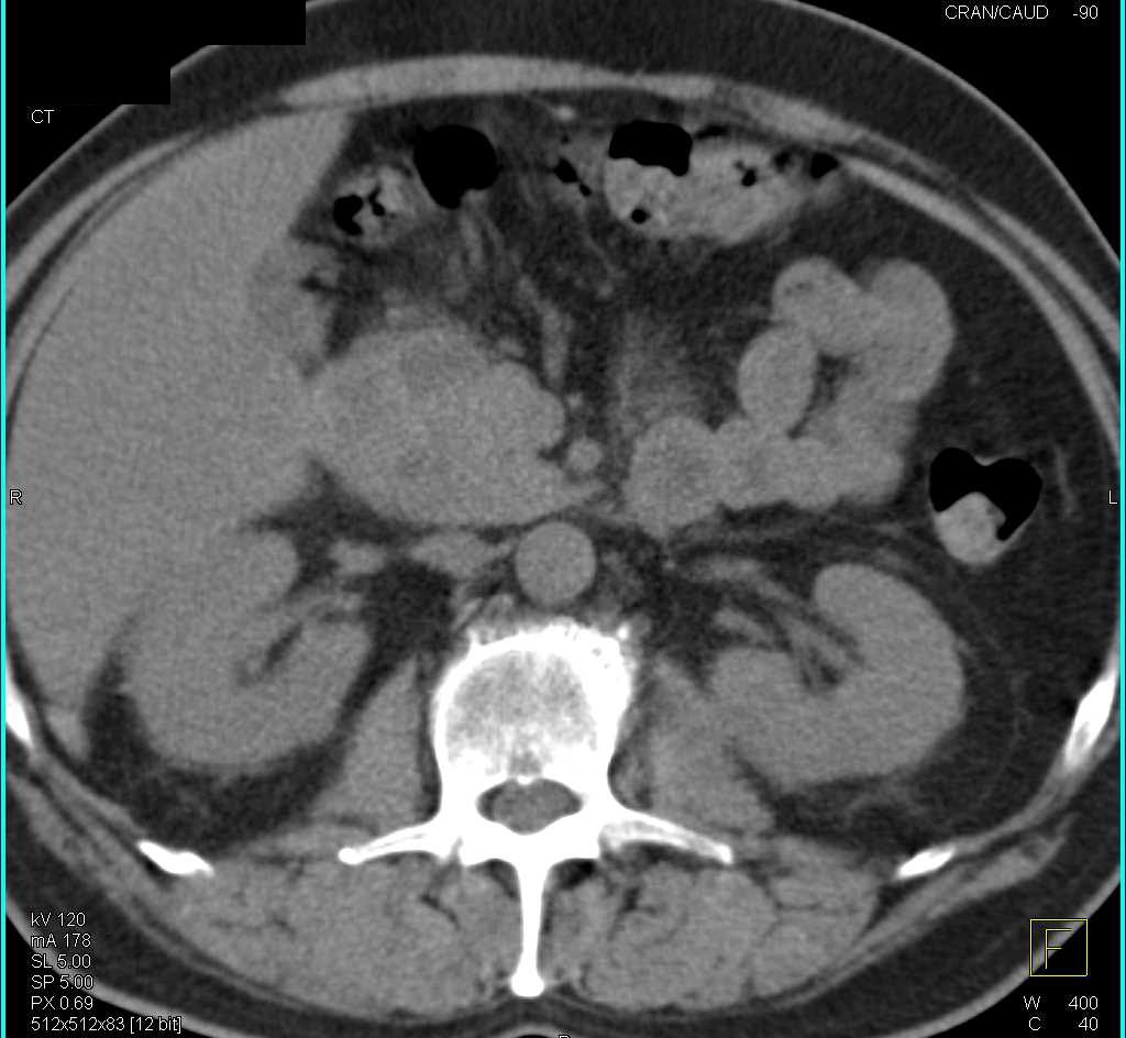 Unusual Case of Groove Pancreatitis - CTisus CT Scan