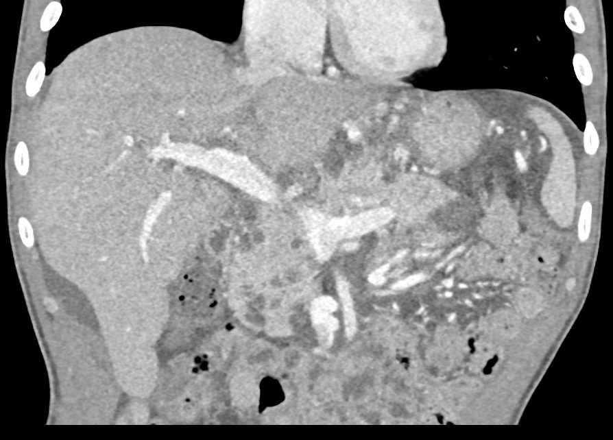 Multiple Intraductal Papillary Mucinous Neoplasms (IPMNs) in the Head of the Pancreas - CTisus CT Scan