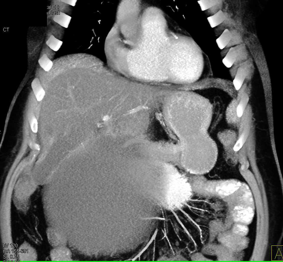 Large Pancreatic Pseudocyst with Mass Effect - CTisus CT Scan