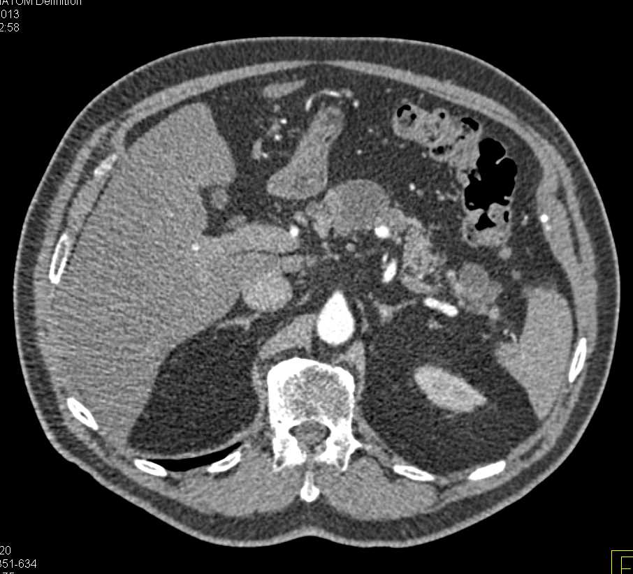 Multiple Intraductal Papillary Mucinous Neoplasms (IPMNs) - CTisus CT Scan