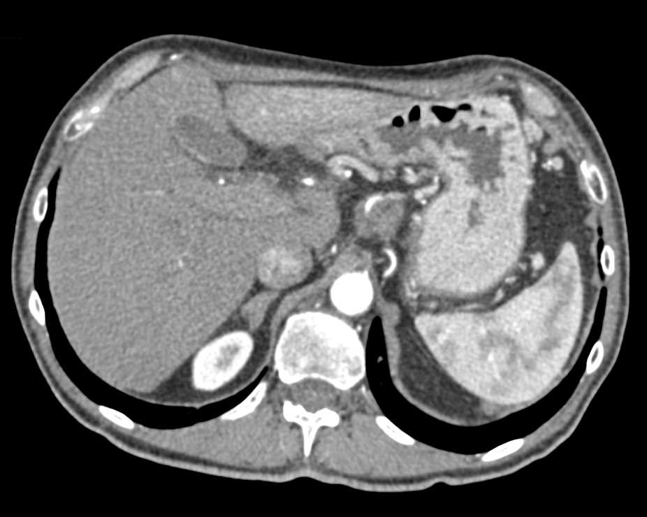 Pancreatic Cancer Encases the Celiac and SMA - CTisus CT Scan