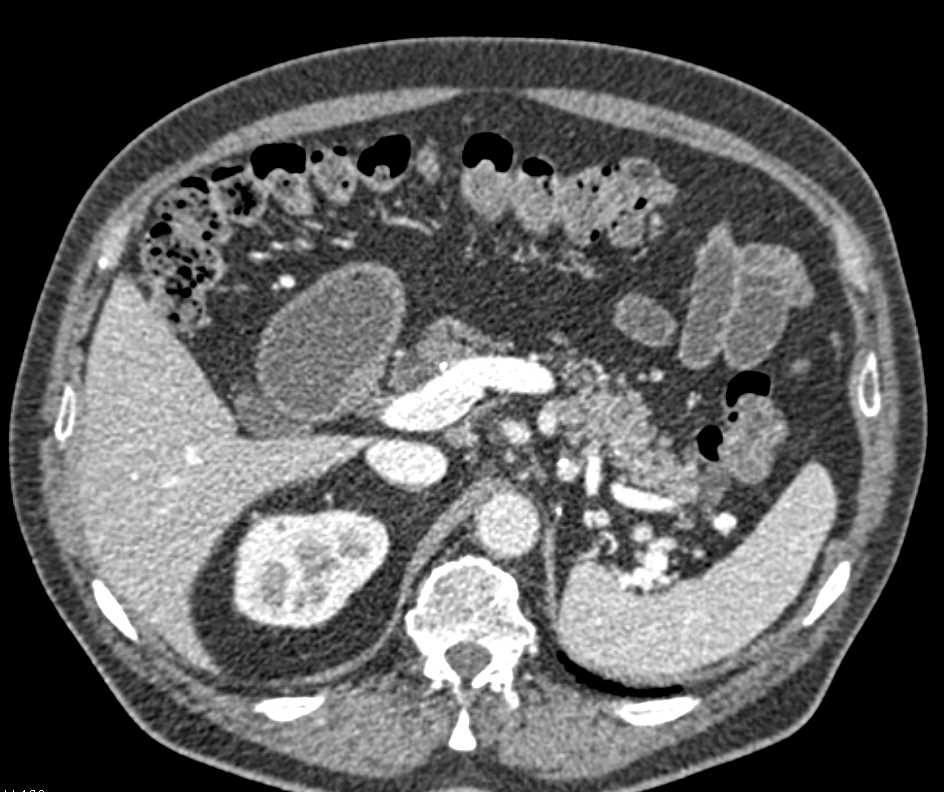 Multiple Intraductal Papillary Mucinous Neoplasms (IPMNs) - CTisus CT Scan