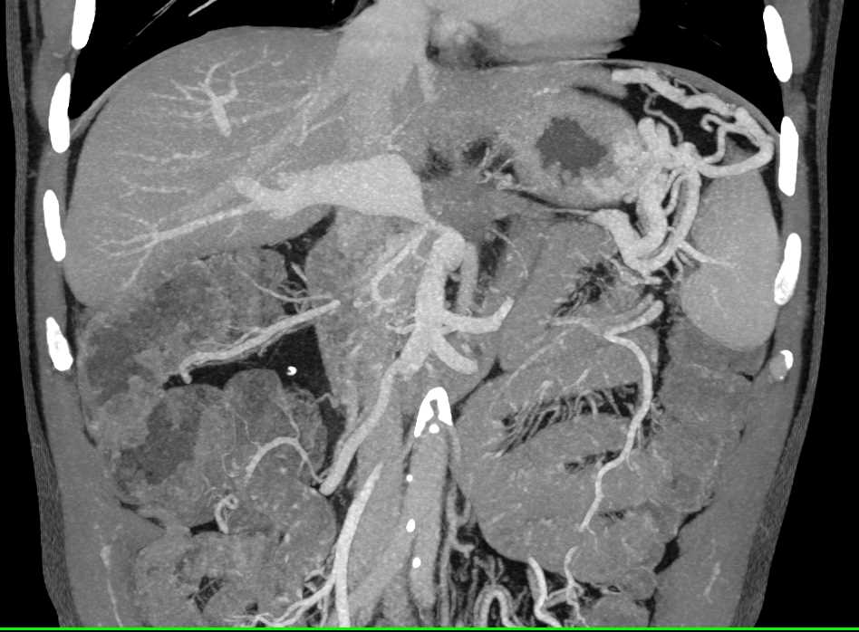 Pancreatic Cancer Encases the Portal Vein and Superior Mesenteric Vein (SMV) and Occludes the Splenic Vein - CTisus CT Scan