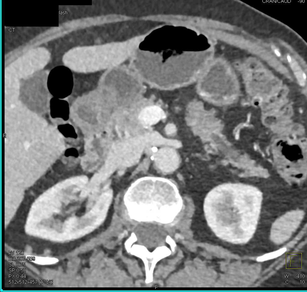 Pancreatic Adenocarcinoma Occludes the Pancreatic Duct - CTisus CT Scan