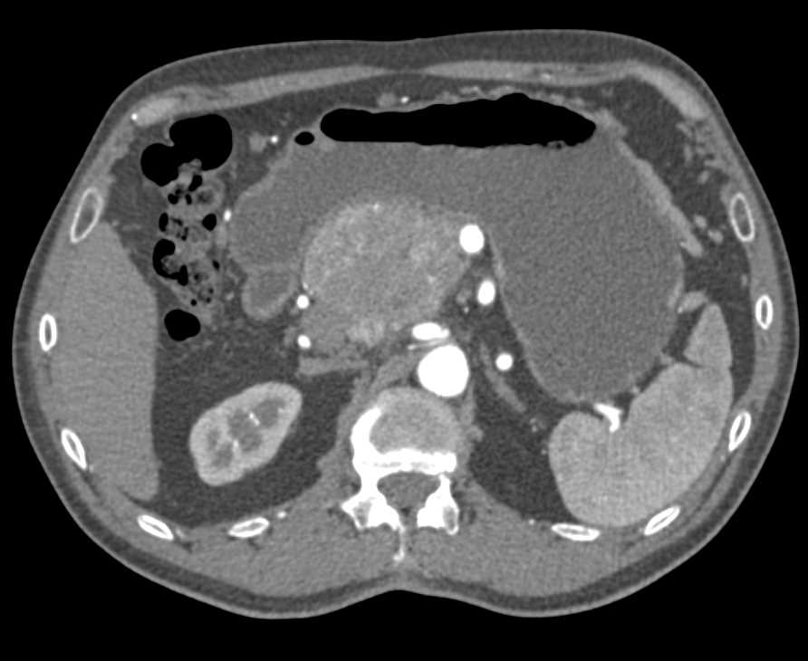 Atypical Neuroendocrine Tumor of the Head of the Pancreas - CTisus CT Scan