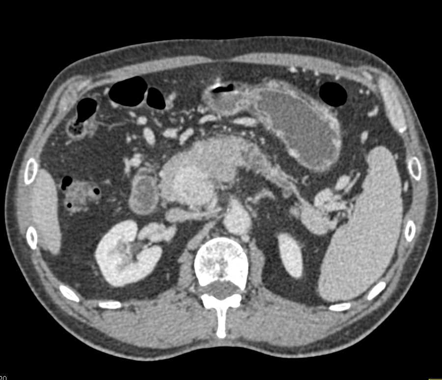 Atypical Neuroendocrine Tumor of the Head of the Pancreas - CTisus CT Scan