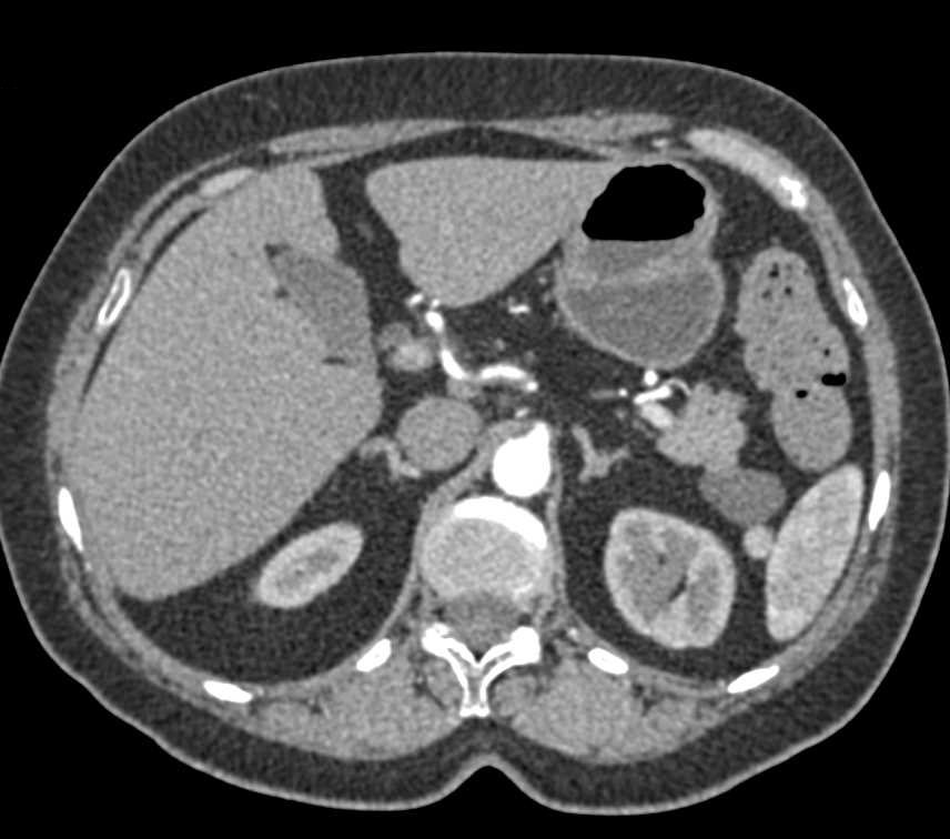 Lymphoepithelial Cyst Tail of Pancreas - CTisus CT Scan