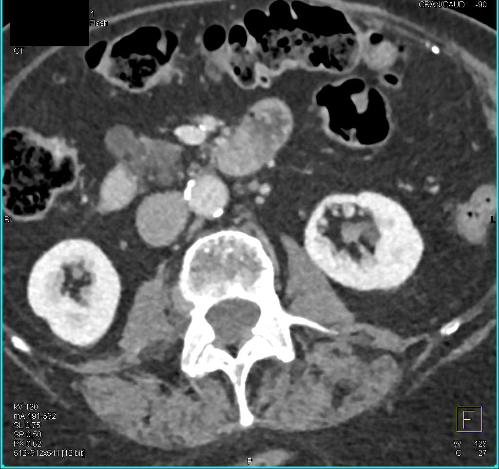 Intraductal Papillary Mucinous Neoplasms (IPMNs) of the Pancreas - CTisus CT Scan