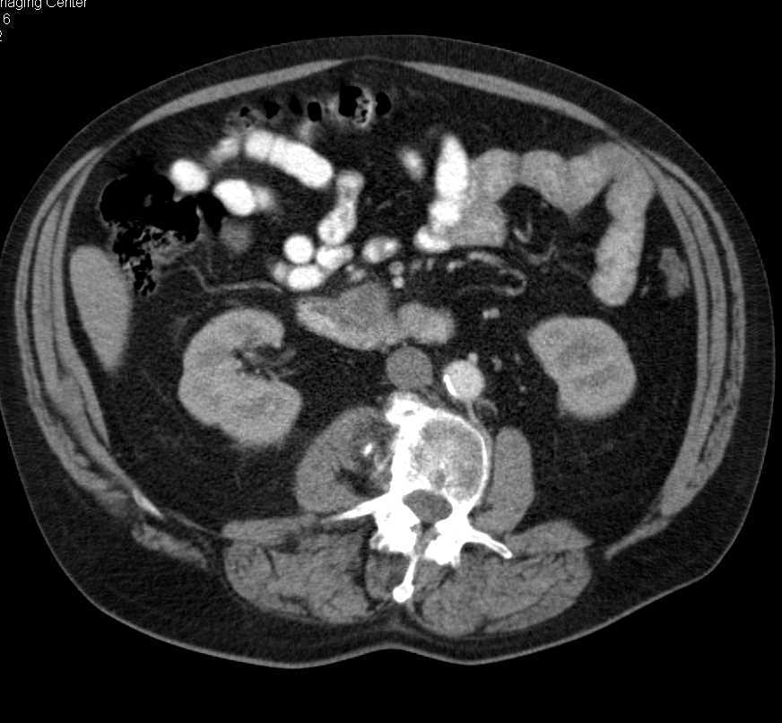 Adenocarcinoma off Uncinate Process - CTisus CT Scan