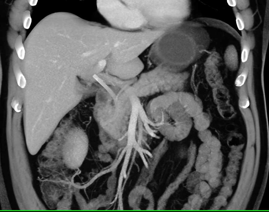 Adenocarcinoma of the Head of the Pancreas - CTisus CT Scan