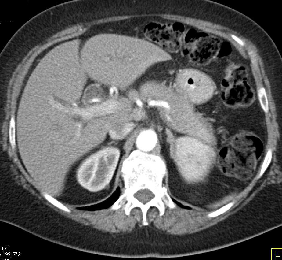 Autoimmune Pancreatitis - CTisus CT Scan