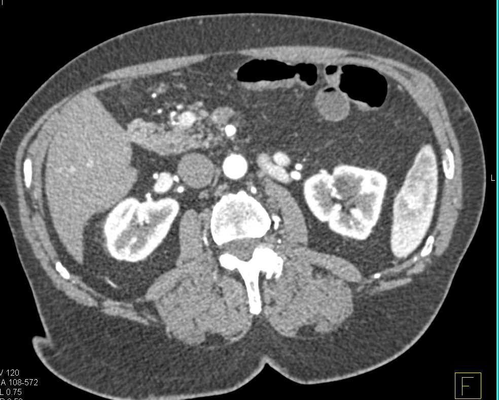 1 cm Neuroendocrine Tumor in the Head of the Pancreas - CTisus CT Scan