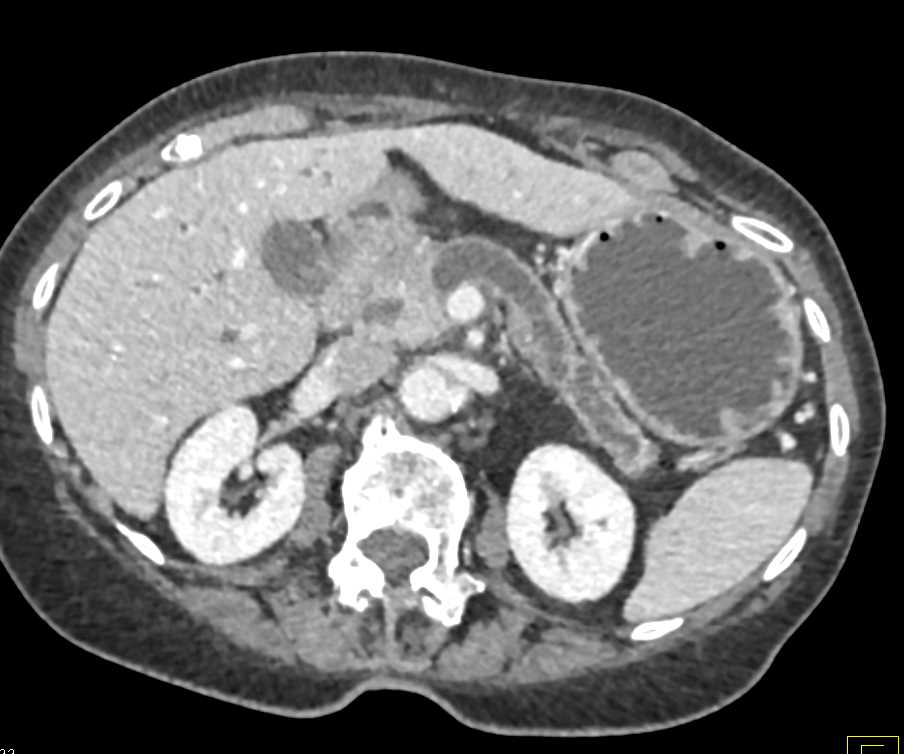 Ampullary Cancer with Huge Pancreatic Duct - CTisus CT Scan