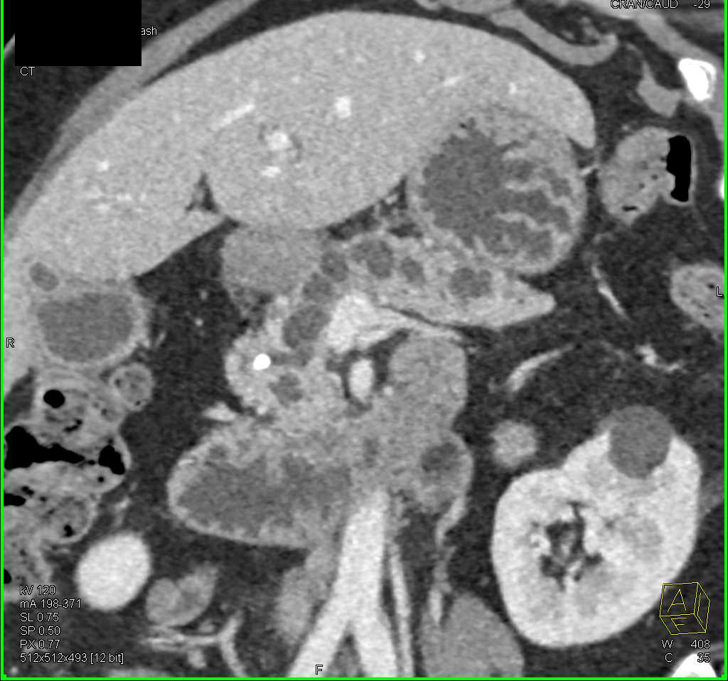 Dilated Pancreatic Duct due to Carcinoma of the Pancreas - CTisus CT Scan