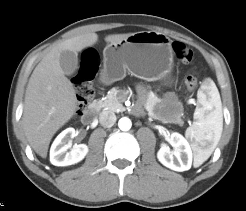 Adenocarcinoma Tail of the Pancreas - CTisus CT Scan