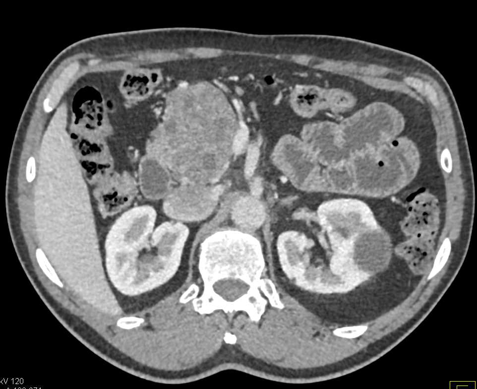 Serous Cystadenoma in the Head of the Pancreas - CTisus CT Scan