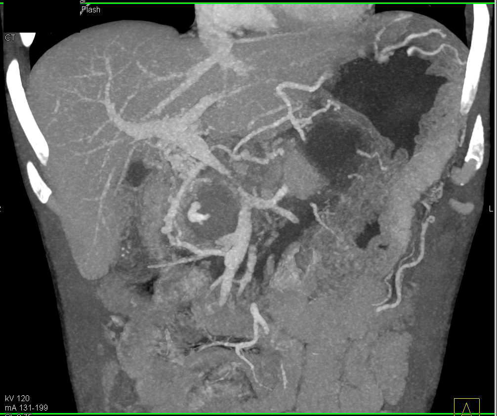 Gastroduodenal Artery (GDA) Bleed Seen on CT Angiogram in a Patient