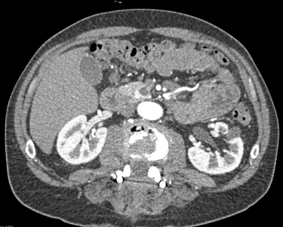 Cystic Neuroendocrine Tumor of the Pancreas - CTisus CT Scan