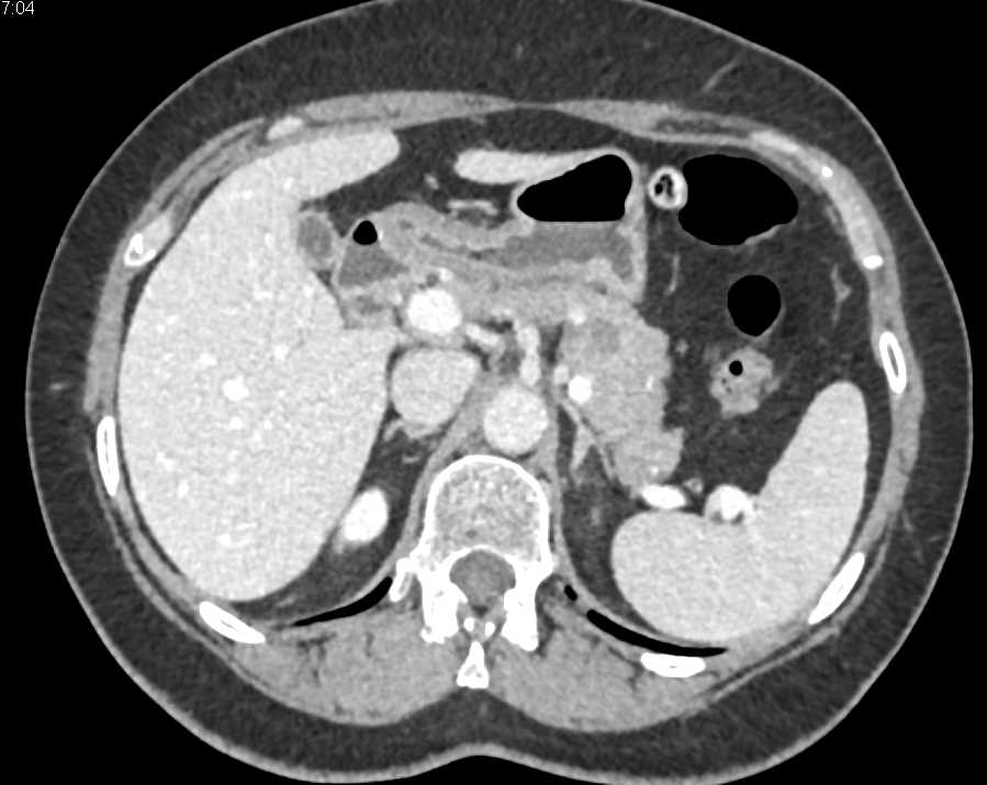 Adenocarcinoma Tail of the Pancreas - CTisus CT Scan